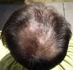 5682560791_66d644b6ce_b_bald-spot